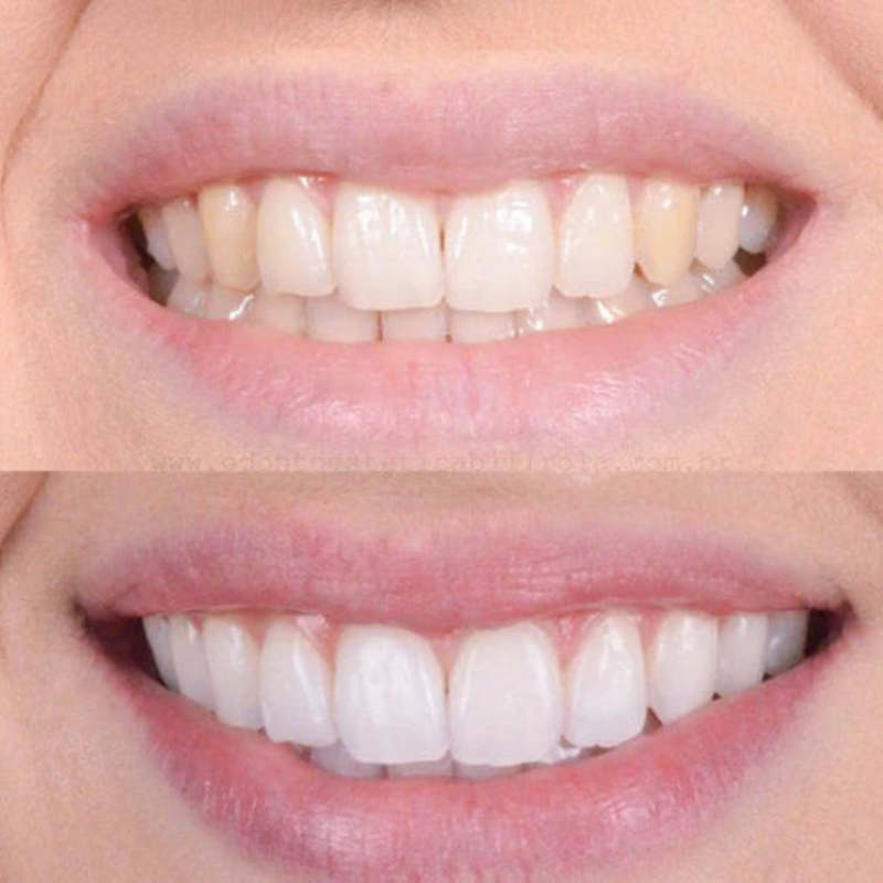 Sbiancamento dei denti rapido per un sorriso splendente